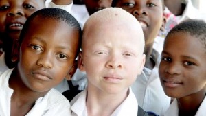 Albinos children